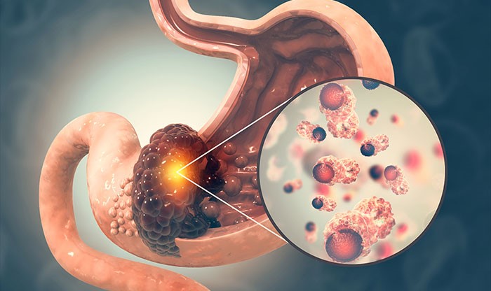 Mide Kanseri Görüntüsü