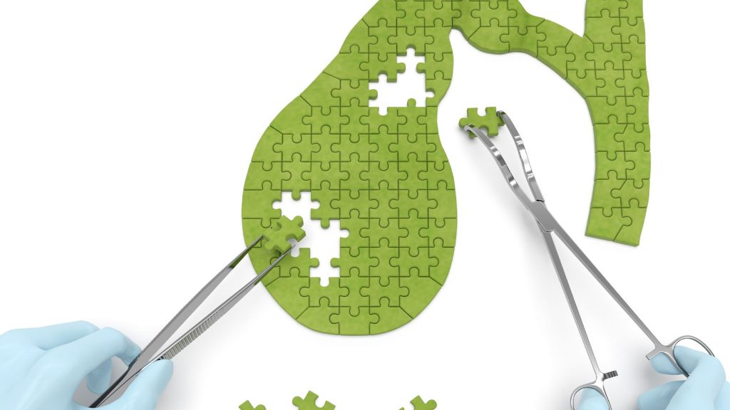 Safra Kesesi Ameliyatı